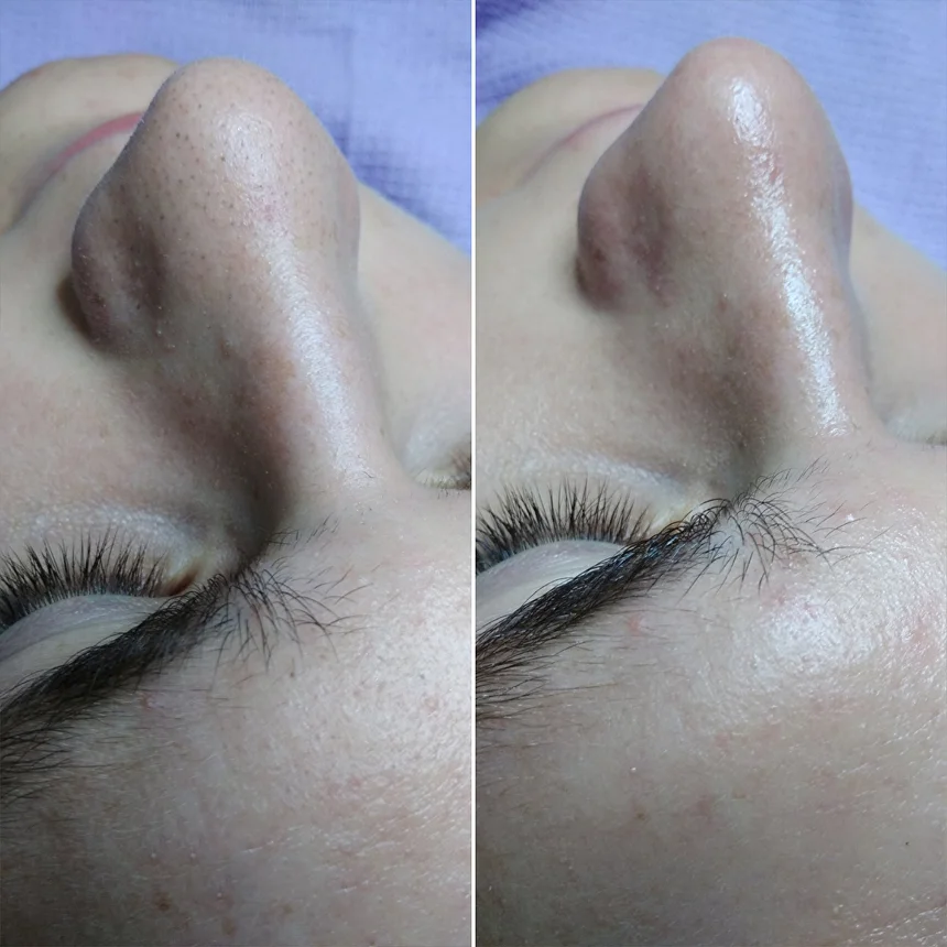 Результати від процедур на пристрої Zemits Skin Expert