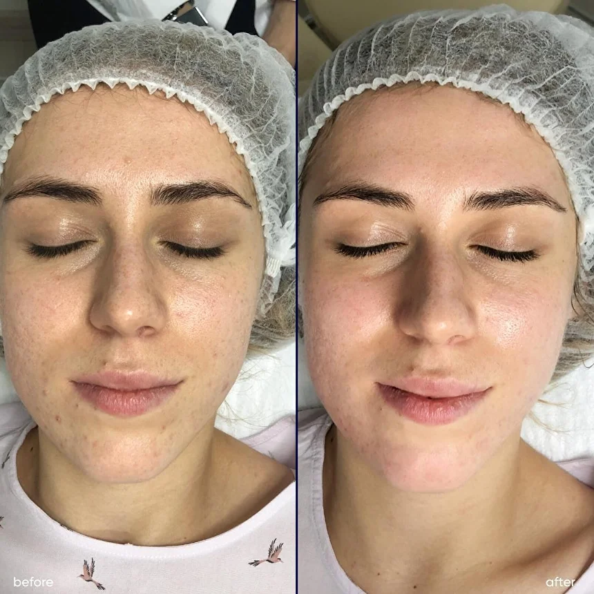 Результати від процедур з ультразвуковим скрабером Zemits Skin Expert